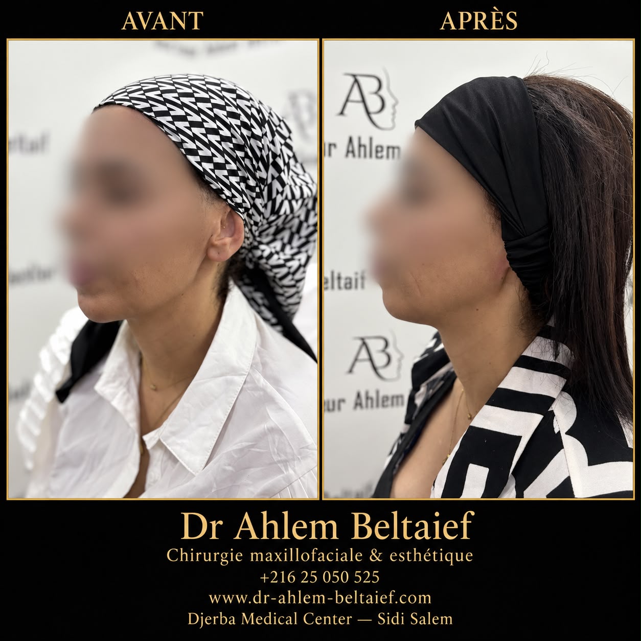 Avant / après injection d'acide hyaluronique jawline et menton, vue de profil