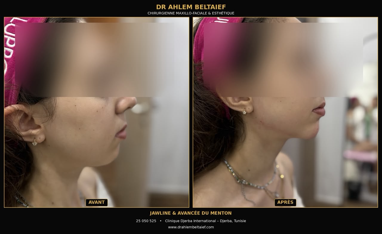 Avant / après acide hyaluronique jawline, vue de trois-quarts
