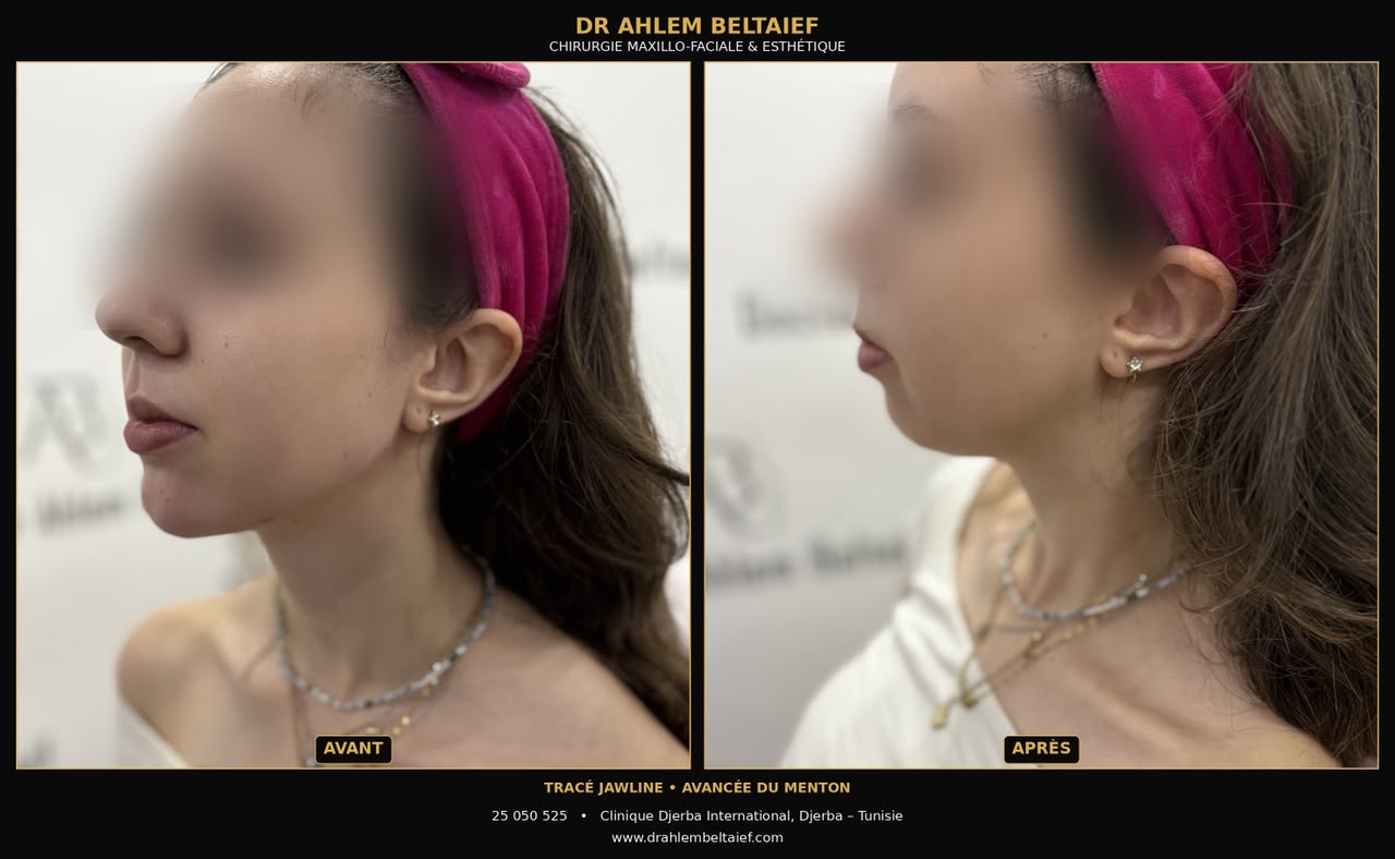 Avant / après acide hyaluronique : jawline et avancée du menton, vue de profil