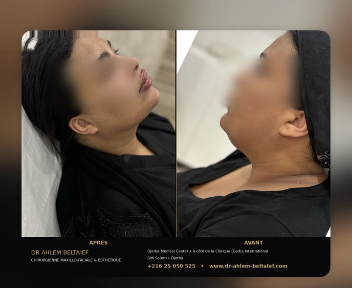 Avant / après injection d'acide hyaluronique au menton