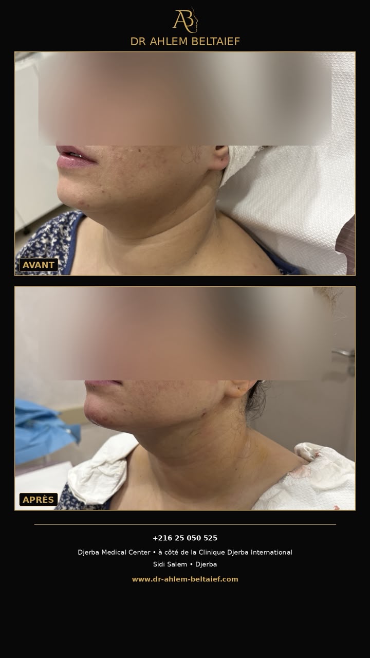 Avant / après acide hyaluronique : redéfinition de l'angle cervico-mentonnier