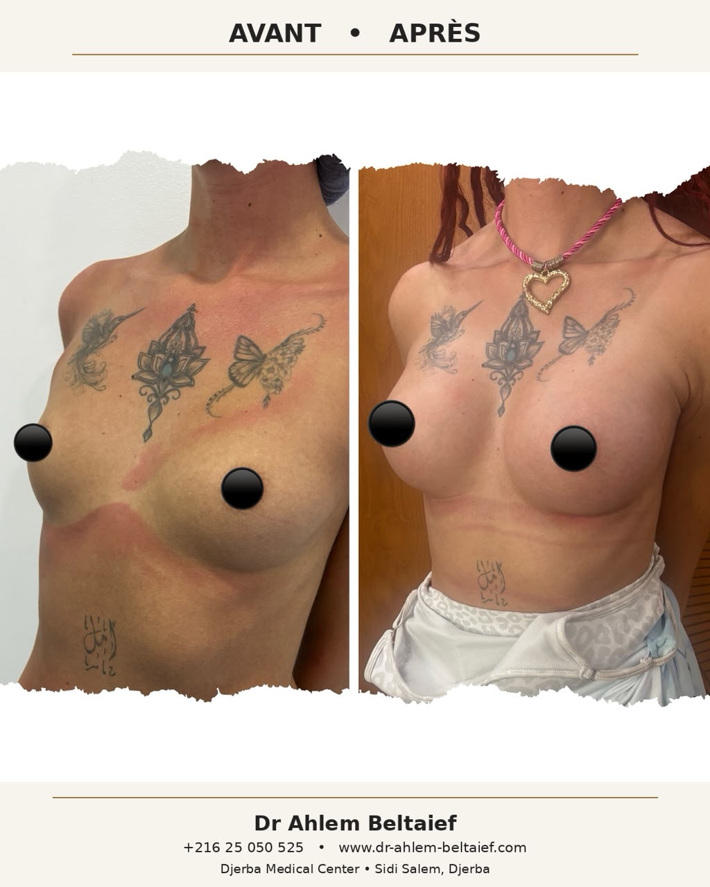 Avant / après augmentation mammaire, vue de trois-quarts