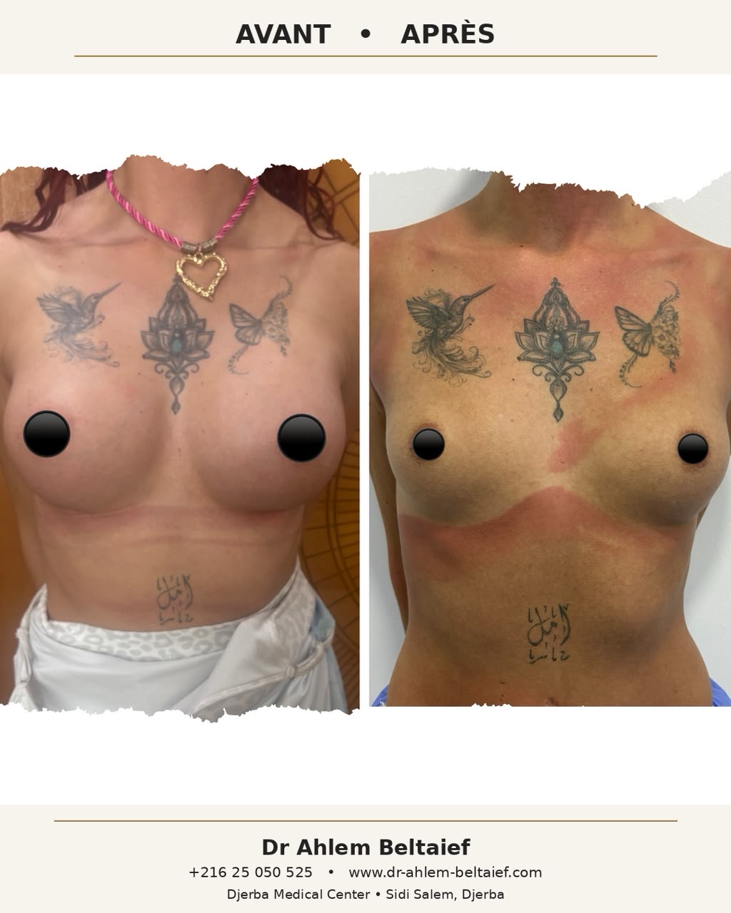 Avant / après augmentation mammaire, autre angle