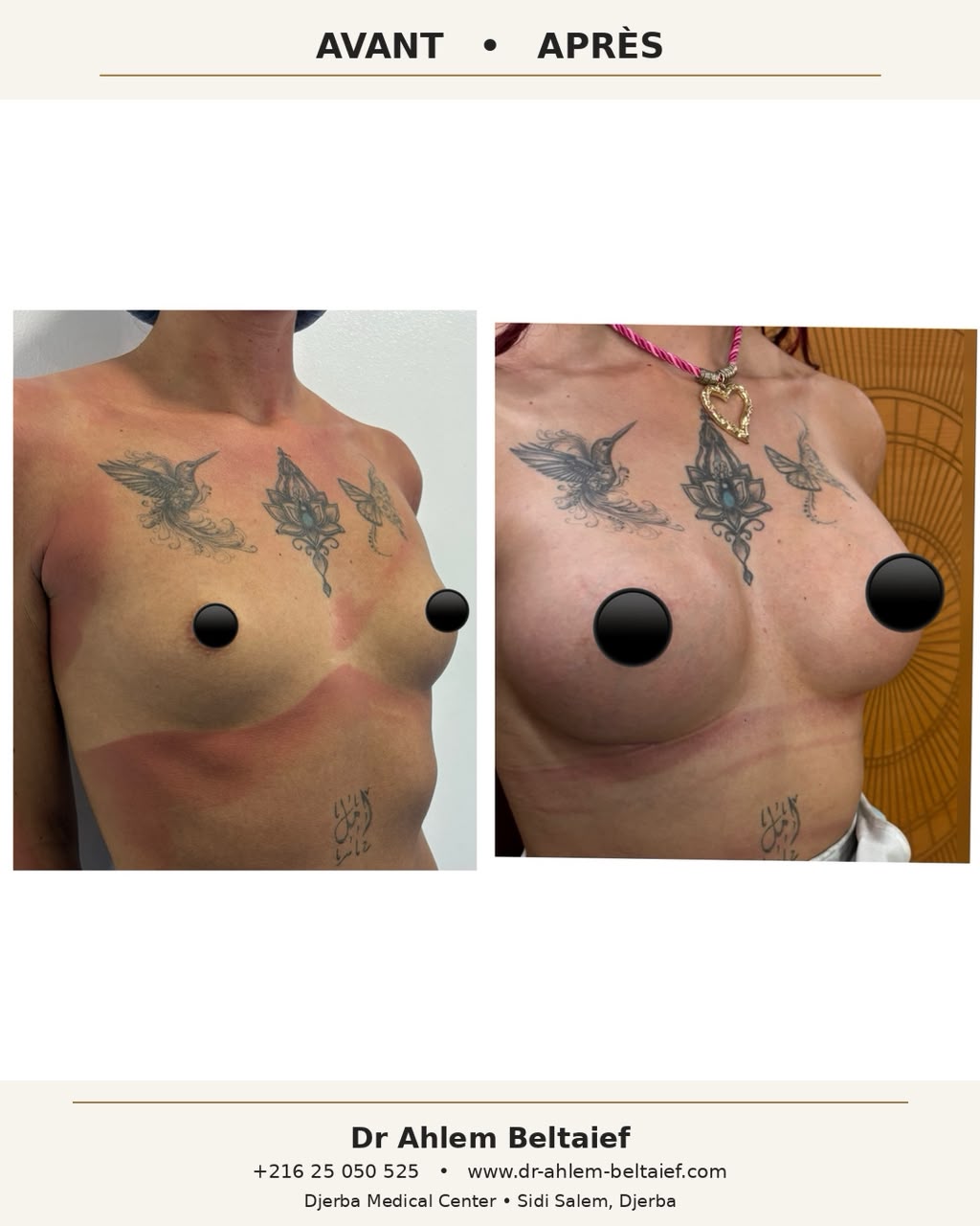Avant / après augmentation mammaire par prothèses